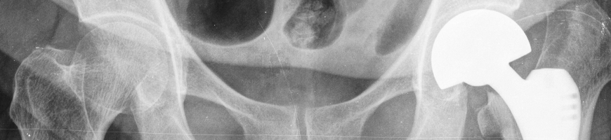 Medical: hip bone implant